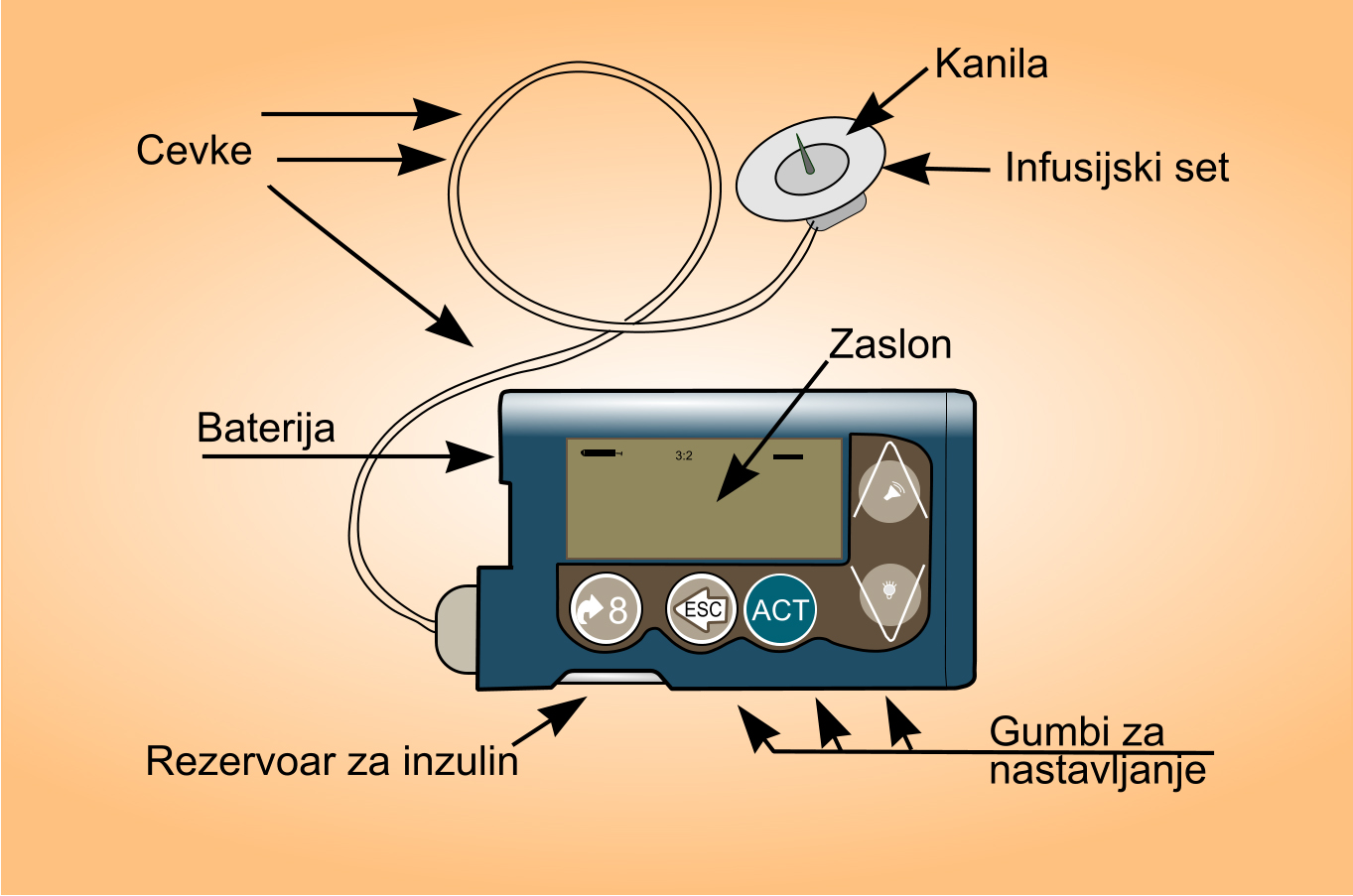 črpalka inzulinska- za vgradnjo